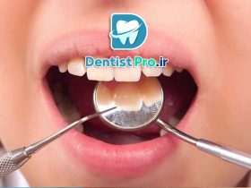 آشنایی با دلایل پوسیدگی دندان پس از کامپوزیت 50 آشنایی با دلایل پوسیدگی دندان پس از کامپوزیت