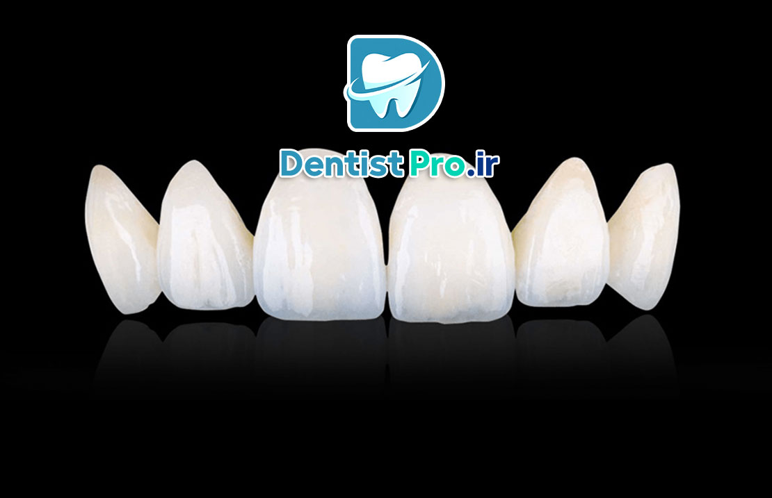 مقدار تراش دندان برای لمینت چقدر باید باشد؟