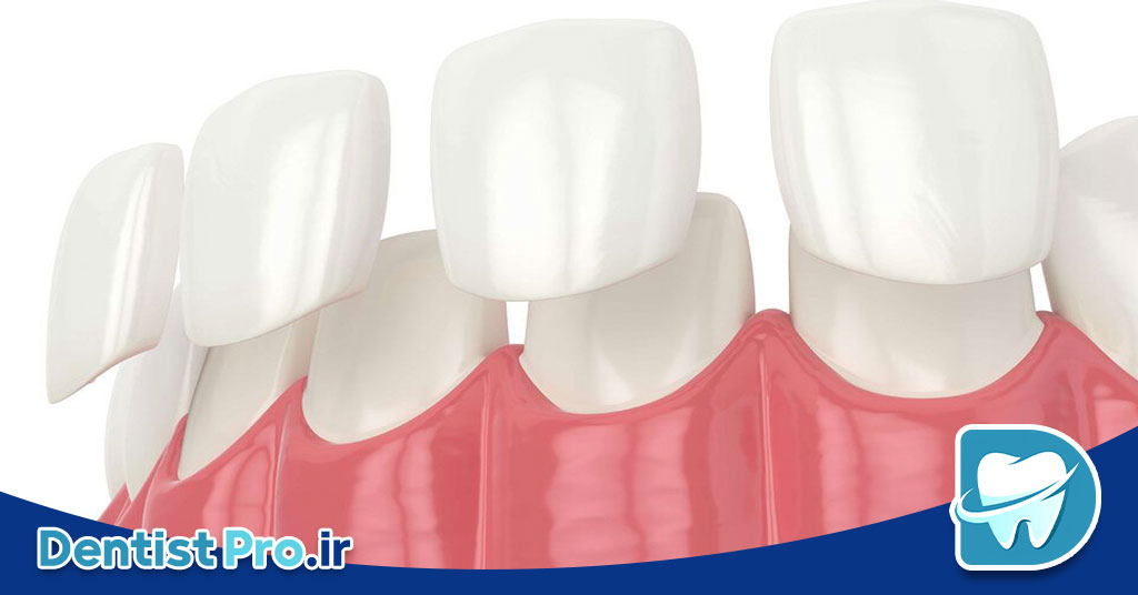 مقدار تراش دندان برای لمینت چقدر باید باشد؟