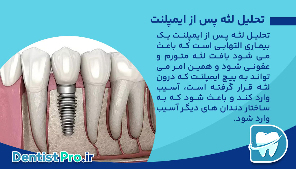 چرا تحلیل لثه پس از ایمپلنت به وجود می آید؟ 27 چرا تحلیل لثه پس از ایمپلنت به وجود می آید؟