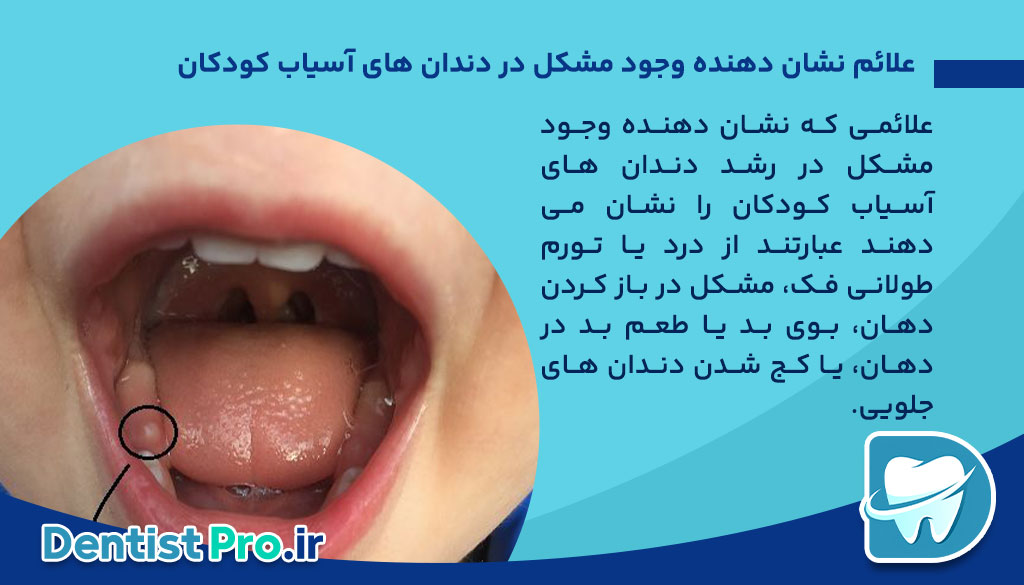 علائم دندان آسیاب در آوردن در کودکان چیست؟