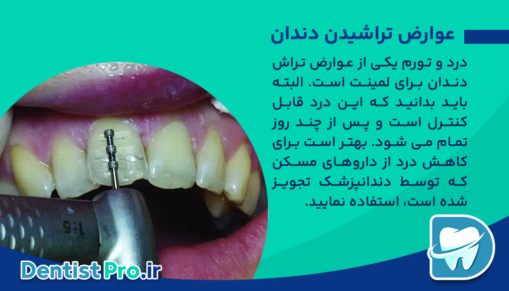 مقدار تراش دندان برای لمینت چقدر باید باشد؟