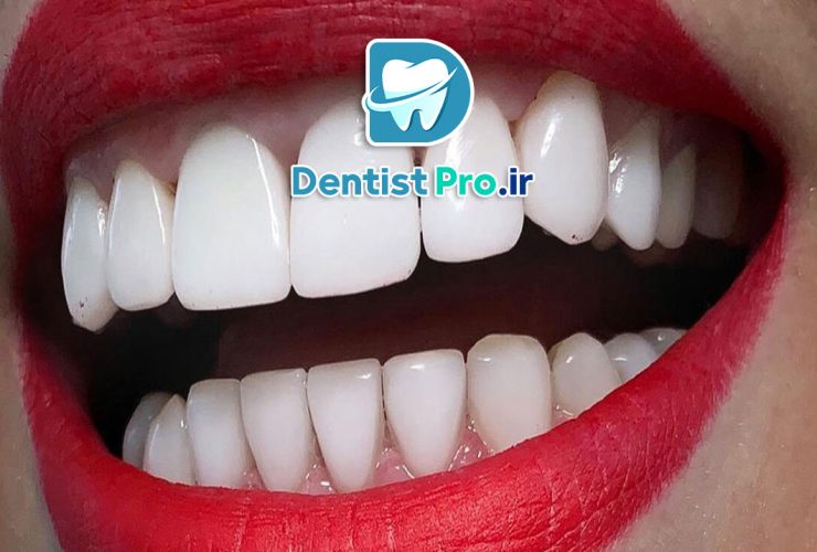 مراقبت های بعد از لمینت دندان