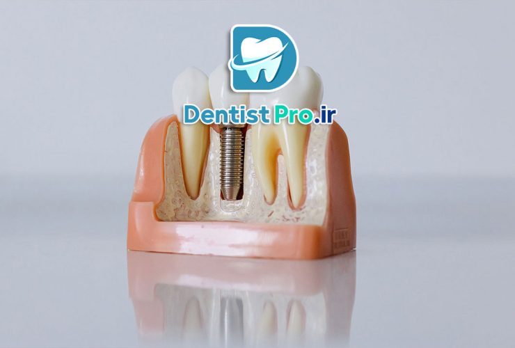 آشنایی با عوارض ایمپلنت دندان، عوارض فیزیکی، روانی و اجتماعی!
