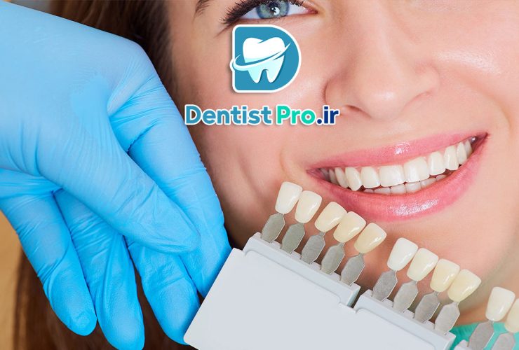 عوارض لمینت دندان