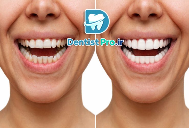 عوارض بلیچینگ دندان چیست؟