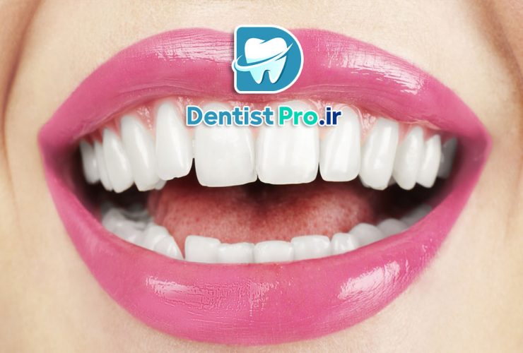 بررسی تاثیر بلیچینگ بر دندان های پر شده