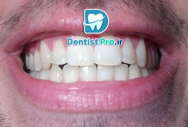 چرا برخی از افراد دندان قروچه می کنند؟