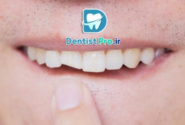 روش های موثر در اصلاح فرم دندان چیست؟