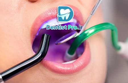 آیا کامپوزیت دندان در یک جلسه امکان پذیر است؟