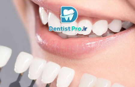 معایب لمینت دندان ارزان+ 9 مورد که باید بدانید