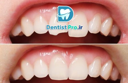جراحی ترمیمی دندان‌ های جلو+ صفر تا صد مطالب مهم