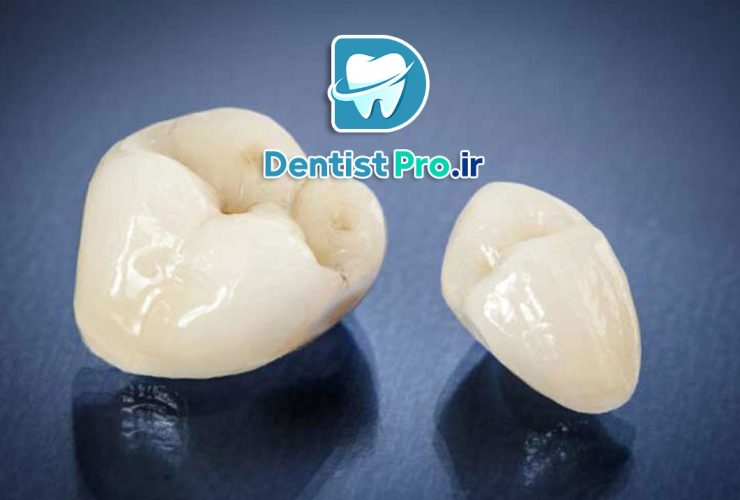 آیا روکش دندان بعد از عصب کشی ضروری است؟