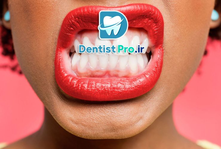 ایمپلنت دندان در افراد مبتلا به دندان قروچه چگونه انجام می شود؟