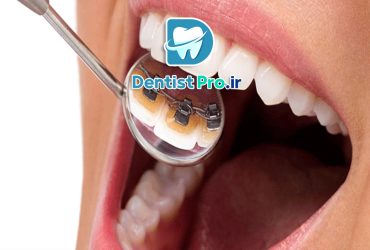 ارتودنسی دندان برای بیماران دیابتی، نکات و توصیه‌های مهم