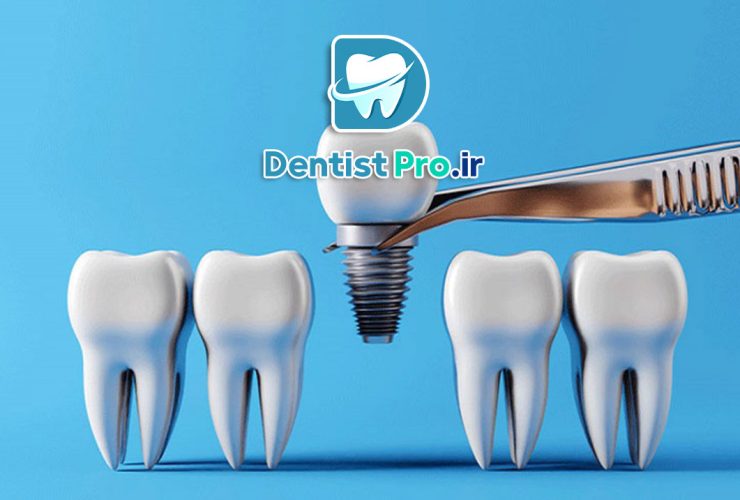 ایمپلنت کره ای ، یکی از بهترین ایمپلنت های بازار