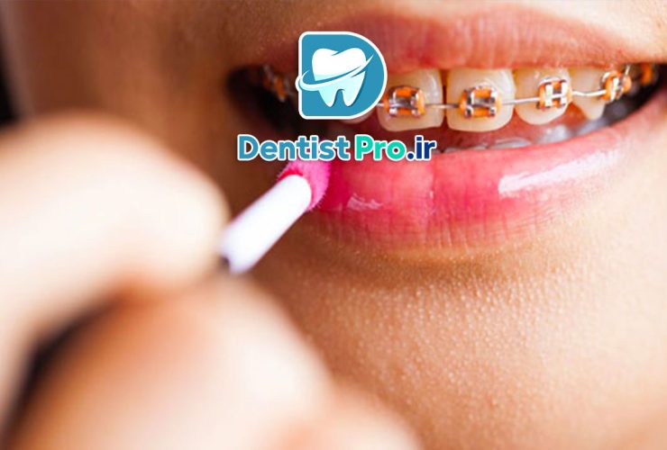 ارتودنسی در افراد سیگاری + نکات ضروری و مهم 48 ارتودنسی در افراد سیگاری + نکات ضروری و مهم