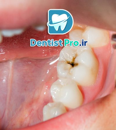 پیشگیری از پوسیدگی دندان، روش‌ها و نکات موثر برای حفظ سلامت دندان‌ها