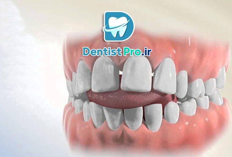 بایت دندان چیست؟ 41 بایت دندان چیست؟