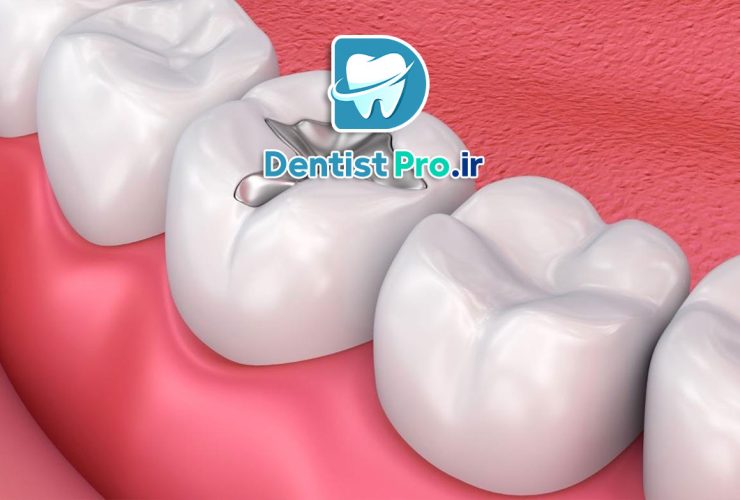 فیلر دندان؛ ترمیمی سریع برای لبخندی زیبا و سالم