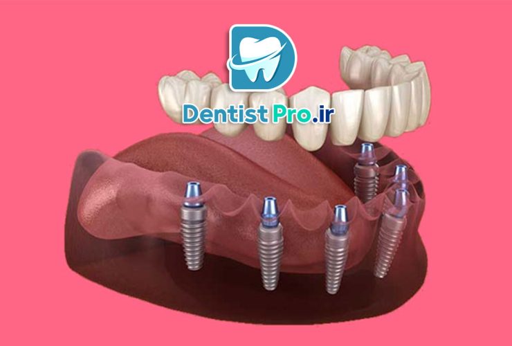 کاشت دندان بدون جراحی: راهی نوین برای بازسازی لبخند