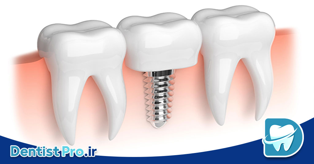 کاشت دندان بدون نیاز به جراحی پیچیده؛ لبخندتان را ساده و سریع بازسازی کنید 27 کاشت دندان بدون نیاز به جراحی پیچیده؛ لبخندتان را ساده و سریع بازسازی کنید