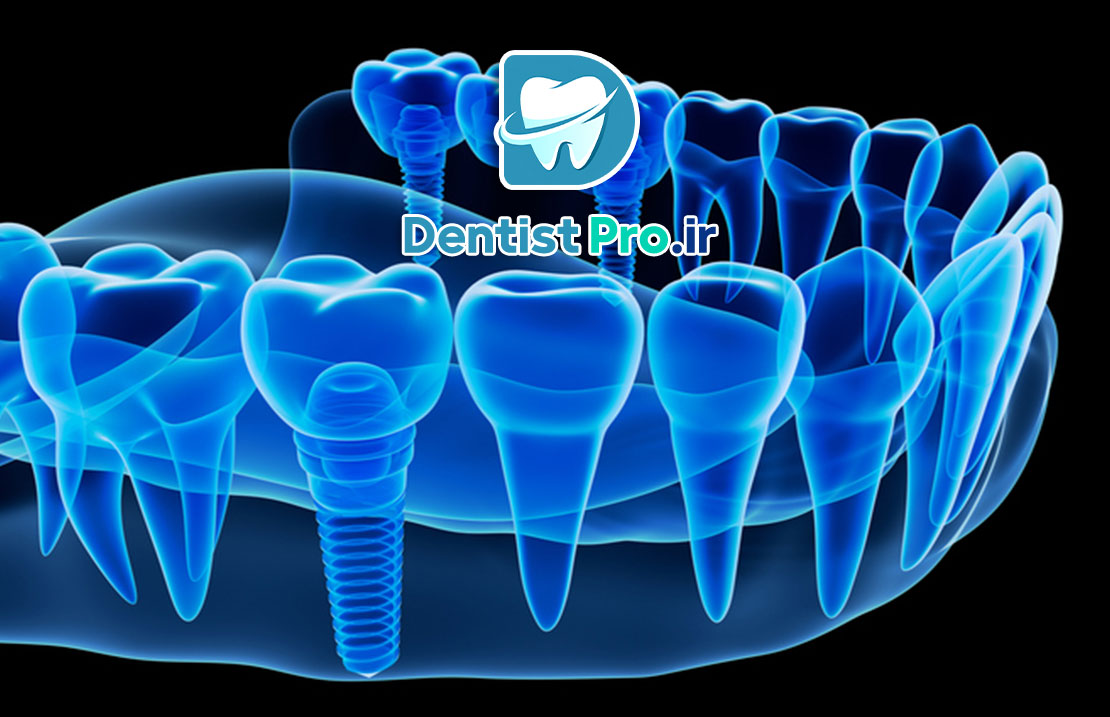 کاشت دندان بدون نیاز به جراحی پیچیده؛ لبخندتان را ساده و سریع بازسازی کنید 25 کاشت دندان بدون نیاز به جراحی پیچیده؛ لبخندتان را ساده و سریع بازسازی کنید