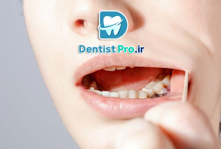 جراحی لثه به روش های نوین؛ تحول در سلامت و زیبایی دهان