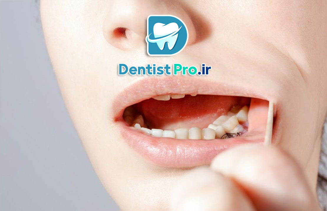 جراحی لثه به روش های نوین؛ تحول در سلامت و زیبایی دهان 25 جراحی لثه به روش های نوین؛ تحول در سلامت و زیبایی دهان