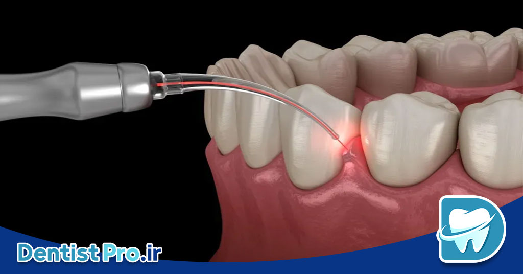 جراحی لثه به روش های نوین؛ تحول در سلامت و زیبایی دهان 29 جراحی لثه به روش های نوین؛ تحول در سلامت و زیبایی دهان
