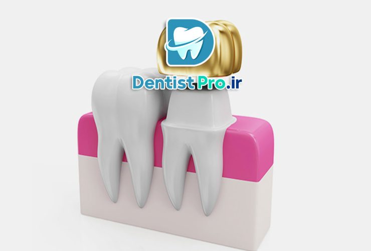 درمان سریع پوسیدگی دندان با روش های نوین+ 10 روش شگفت آور
