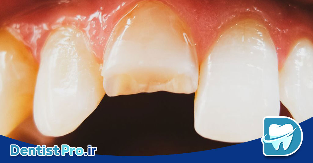 ترمیم دندان های شکسته؛ بازگرداندن لبخند شما با روشهای نوین 27 ترمیم دندان های شکسته؛ بازگرداندن لبخند شما با روشهای نوین