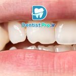 ترمیم دندان های شکسته؛ بازگرداندن لبخند شما با روش‌های نوین