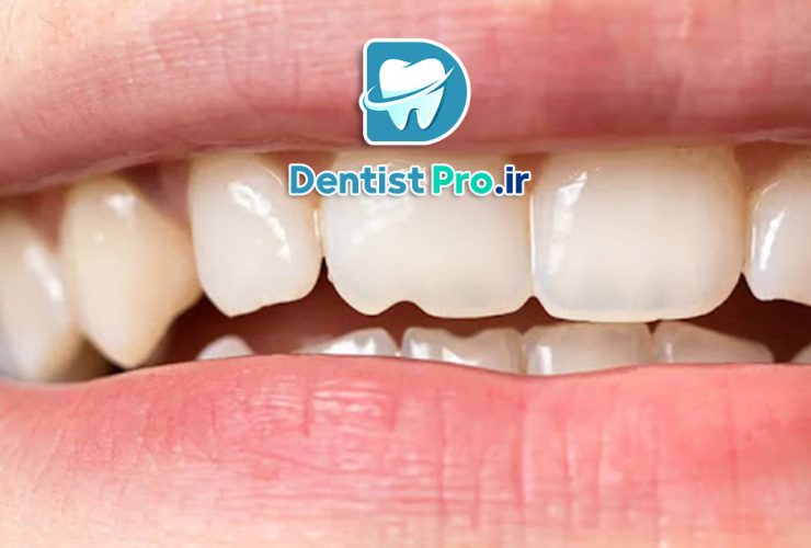 ترمیم دندان های شکسته؛ بازگرداندن لبخند شما با روش‌های نوین