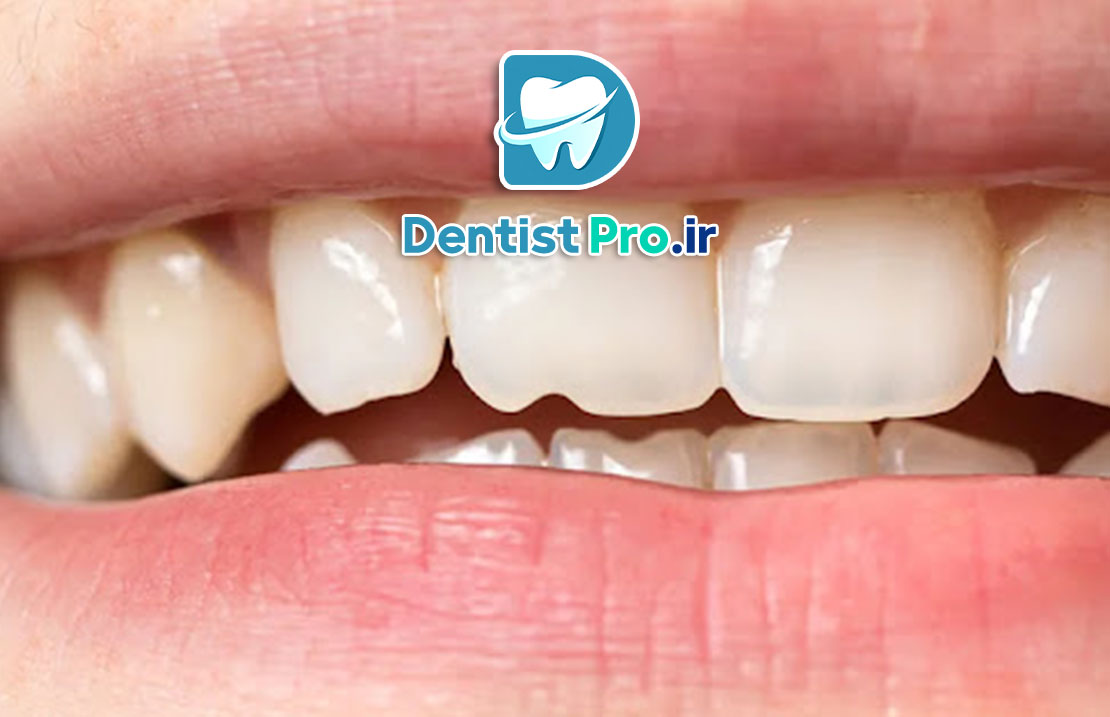 ترمیم دندان های شکسته؛ بازگرداندن لبخند شما با روشهای نوین 25 ترمیم دندان های شکسته؛ بازگرداندن لبخند شما با روشهای نوین