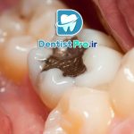 ترمیم دندان های آسیب دیده با مواد عالی؛ بازسازی لبخند با ماندگاری بالا