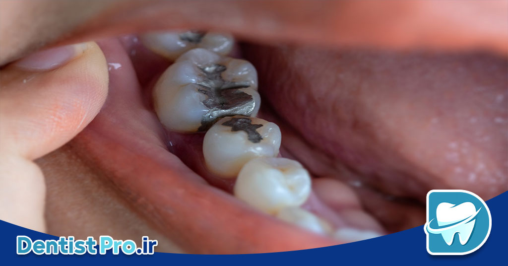 ترمیم دندان های آسیب دیده با مواد عالی؛ بازسازی لبخند با ماندگاری بالا 29 ترمیم دندان های آسیب دیده با مواد عالی؛ بازسازی لبخند با ماندگاری بالا