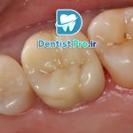 ترمیم دندان ها با مواد درجه یک؛ ترکیبی از دوام، زیبایی و سلامت