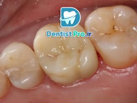 ترمیم دندان ها با مواد درجه یک؛ ترکیبی از دوام، زیبایی و سلامت