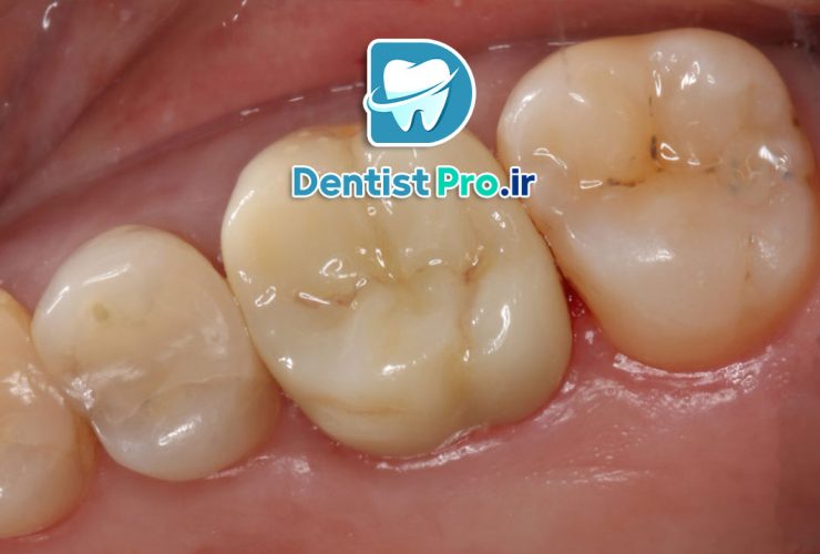 ترمیم دندان ها با مواد درجه یک؛ ترکیبی از دوام، زیبایی و سلامت 27 ترمیم دندان ها با مواد درجه یک؛ ترکیبی از دوام، زیبایی و سلامت