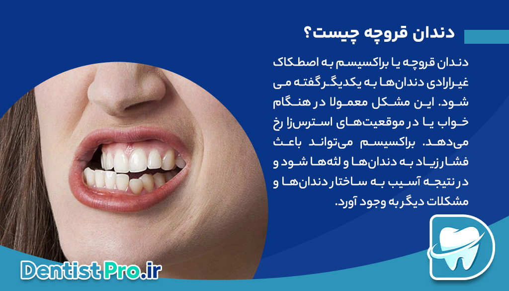 ایمپلنت دندان در افراد مبتلا به دندان قروچه چگونه انجام می شود؟ 26 ایمپلنت دندان در افراد مبتلا به دندان قروچه چگونه انجام می شود؟