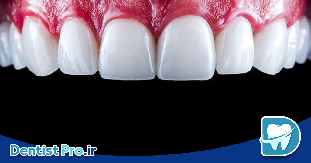 لمینت تمام سرامیک: راهکاری حرفه‌ای برای لبخندی درخشان و طبیعی