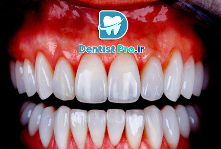 لمینت تمام سرامیک: راهکاری حرفه‌ای برای لبخندی درخشان و طبیعی