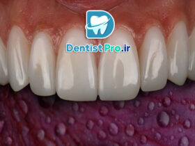 کامپوزیت دندان آنتی استین+راهکاری برای لبخندی ماندگار و بدون تغییر رنگ 68 کامپوزیت دندان آنتی استین+راهکاری برای لبخندی ماندگار و بدون تغییر رنگ
