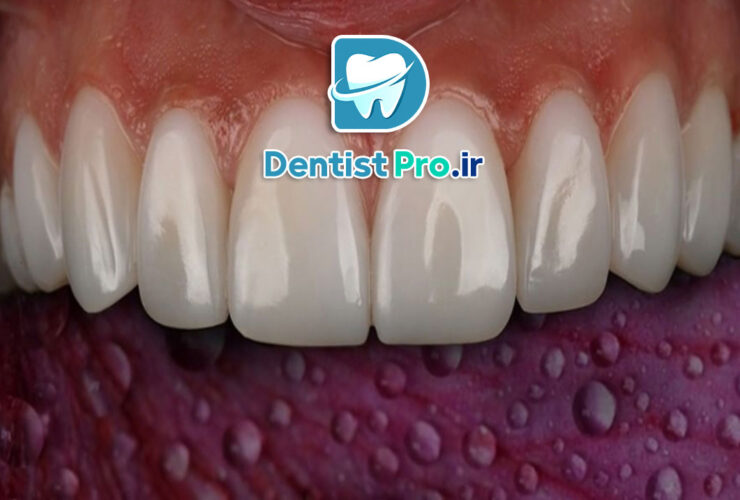 کامپوزیت دندان آنتی استین+راهکاری برای لبخندی ماندگار و بدون تغییر رنگ