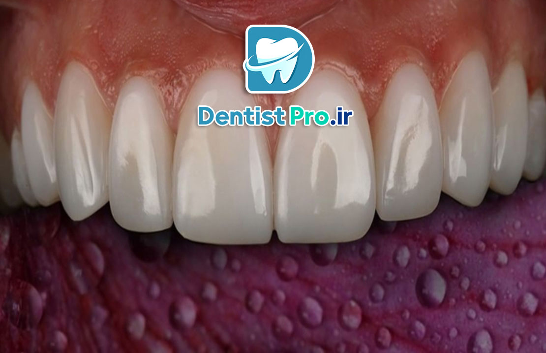 کامپوزیت دندان آنتی استین+راهکاری برای لبخندی ماندگار و بدون تغییر رنگ