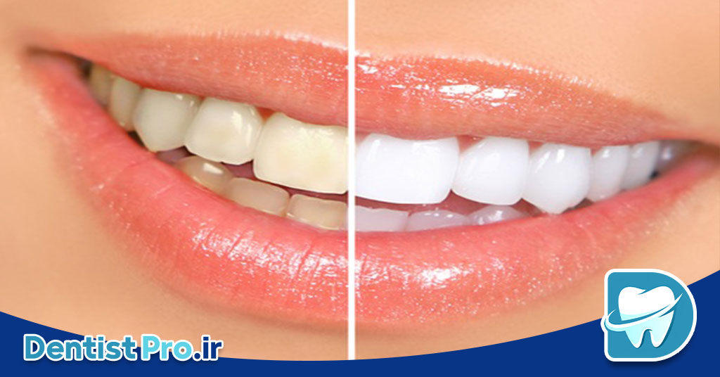  کامپوزیت دندان آنتی استین+راهکاری برای لبخندی ماندگار و بدون تغییر رنگ 