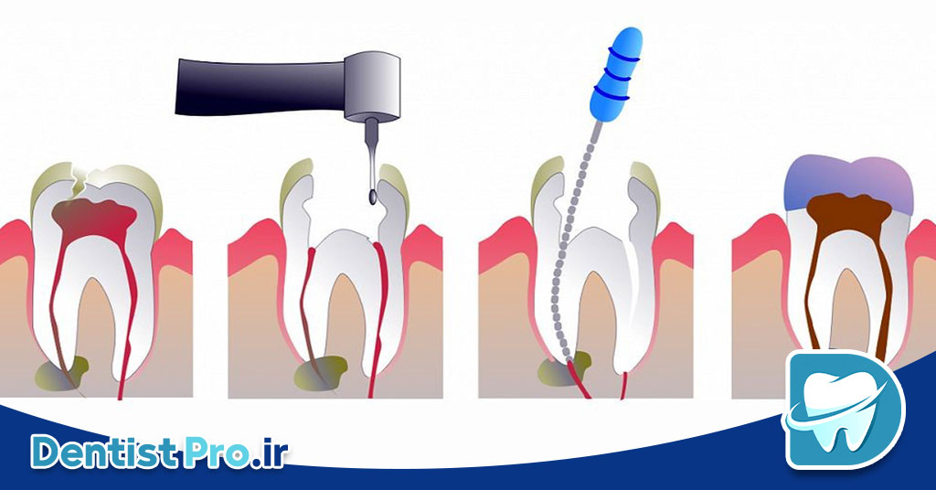 درمان پالپ دندان شیری: راهنمای جامع حفظ سلامت دندان‌های کودکان