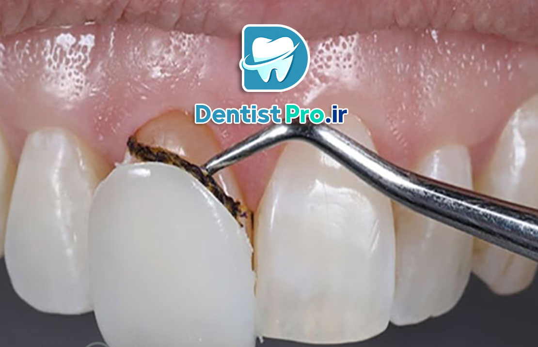 خراب شدن لمینت دندان: علل، عوارض و راه‌های پیشگیری