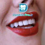 کامپوزیت مخصوص لبخندهای خاص؛ هنر لبخندسازی برای چهره‌های منحصربه‌فرد